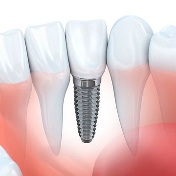 Bilbident proceso de implante dental